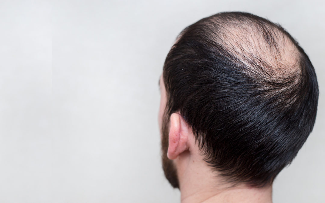 Залысина на затылке у женщин. Выпадение волос абстракция. Comparison of alopecia Areata.