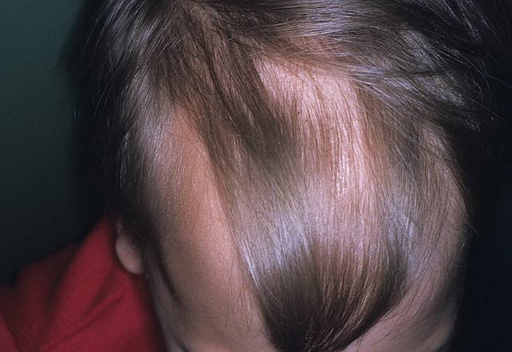 9 лет выпадают волосы. Очаговая алопеция у детей.