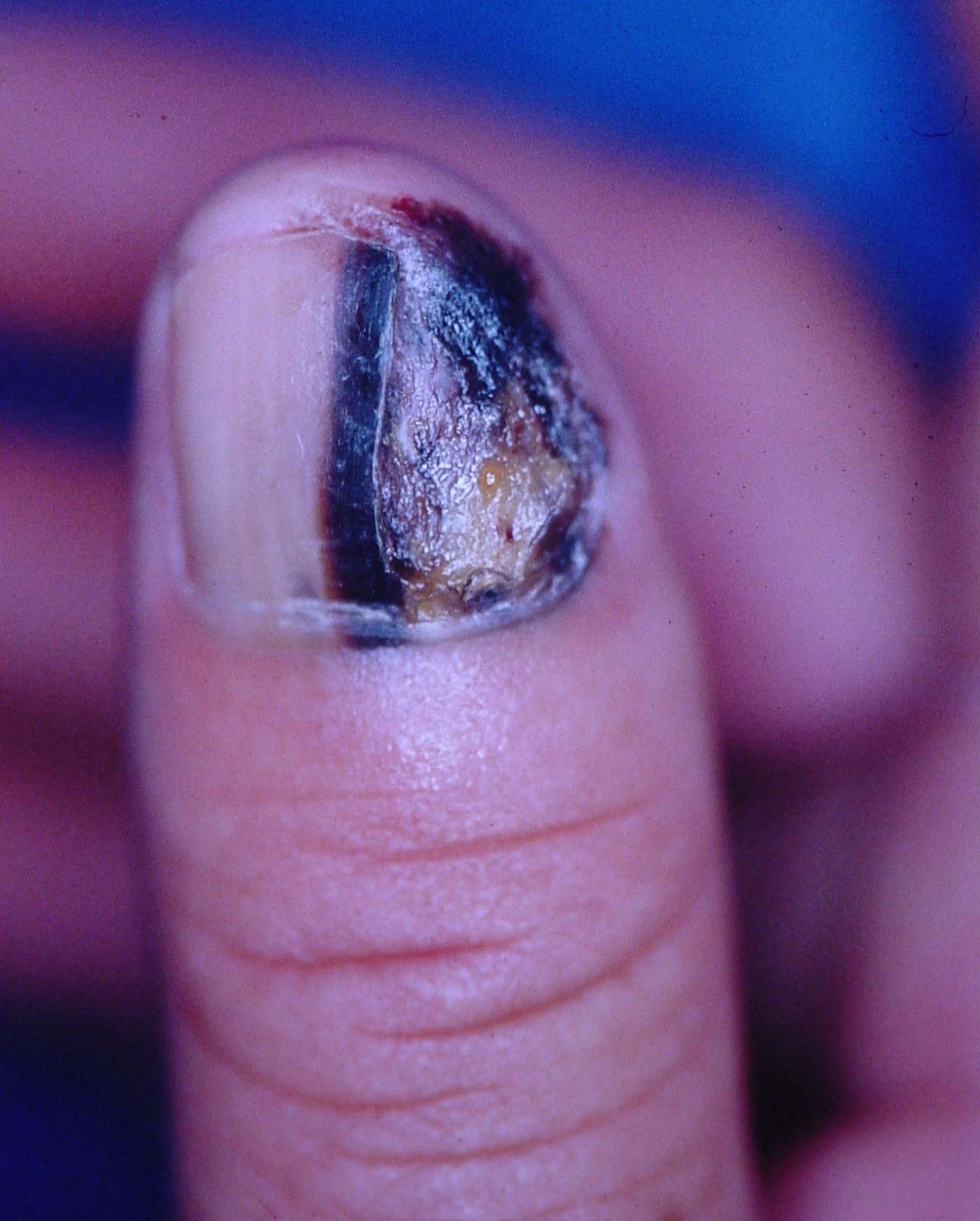 Болезнь ногтей фото и описание