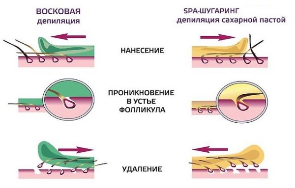 Схема шугаринга и ваксинга