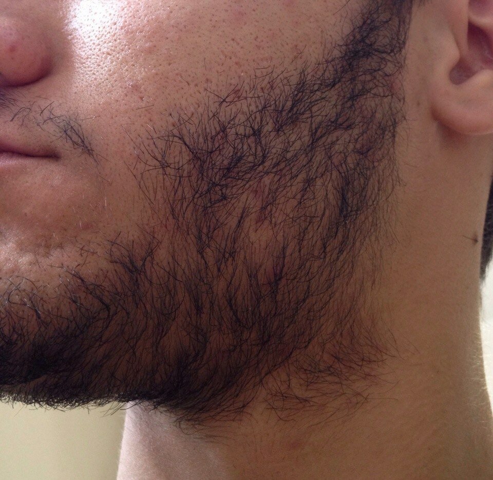 Рост волос на лице у мужчин. Неравномерная щетина. Густая борода. Волосы на лице у мужчин. Рост бороды.
