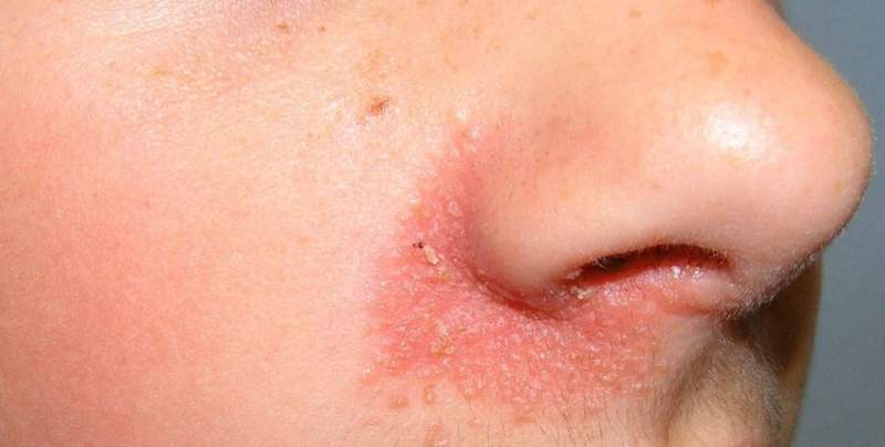 Себорейный дерматит вокруг крыльев носа как лечить