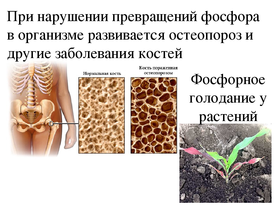 Избыток фосфора. Недостаток фосфора в организме приводит к. Недостаток и избыток фосфора в организме. Избыток и недостаток фосфора в организме человека. Болезни связанные с недостатком фосфора.