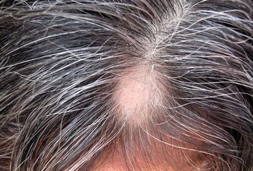 Причины выпадения волос: Очаговая алопеция