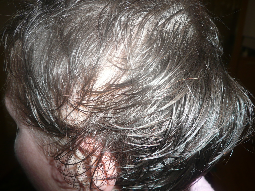 Волосы на затылке торчат. Выпадение волос после химиотерапии. После химии выпадают волосы.