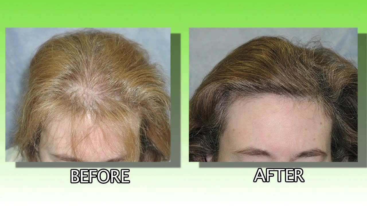 Как вы восстанавливали волосы после выпадения