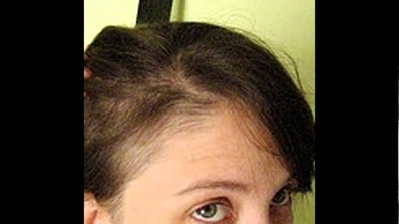 Выпадение волос при бусерелине