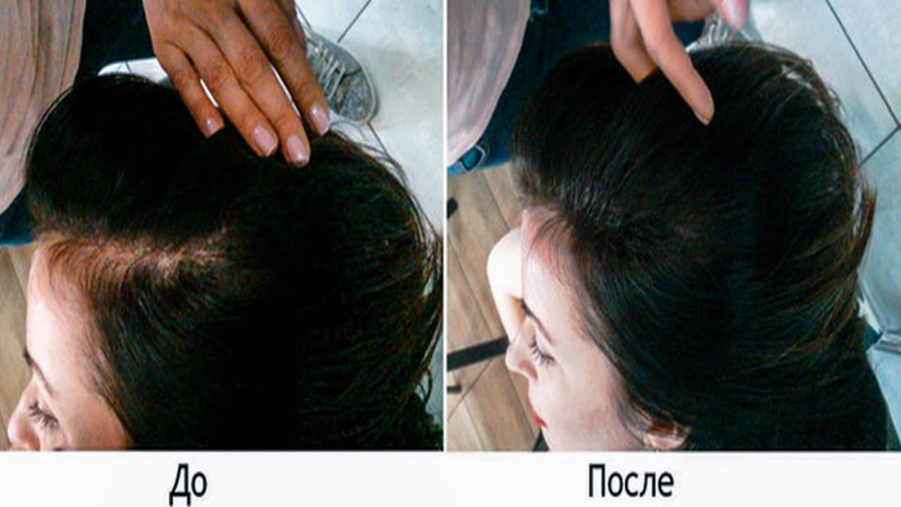 Как восстановить выпавшие волосы