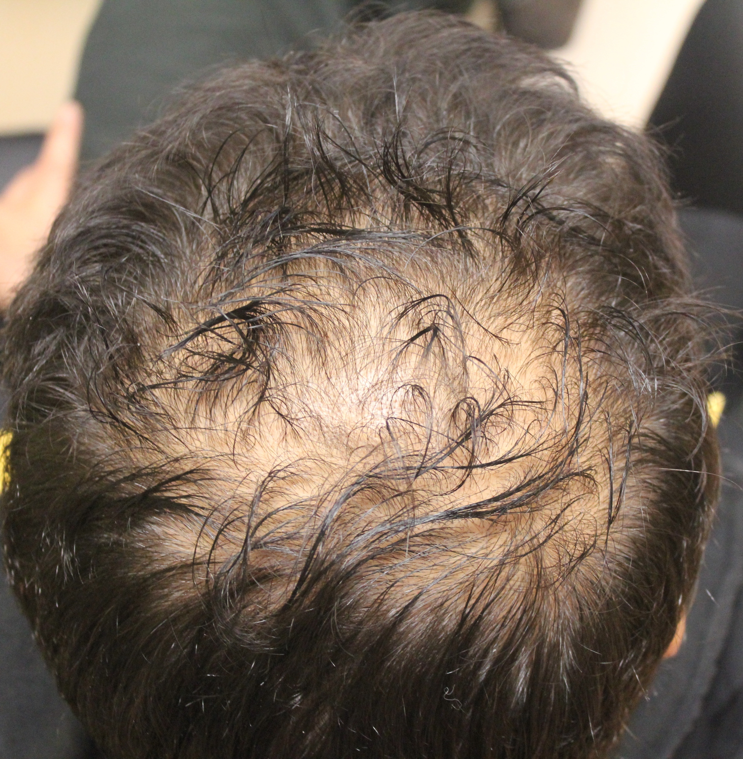 Почему выпадают волосы на голове у мужчин причины в большом количестве