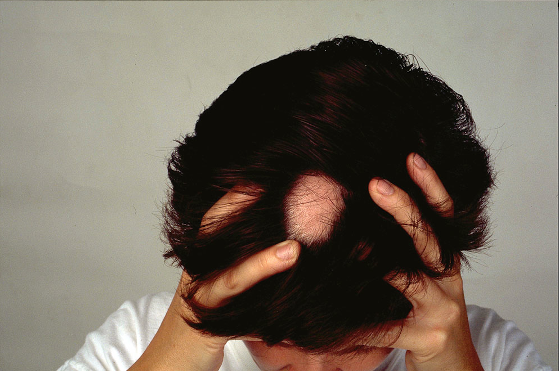Выпадают волосы на руках. Очаговая алопеция (alopecia Areata). Выпадение волос у мужчин.