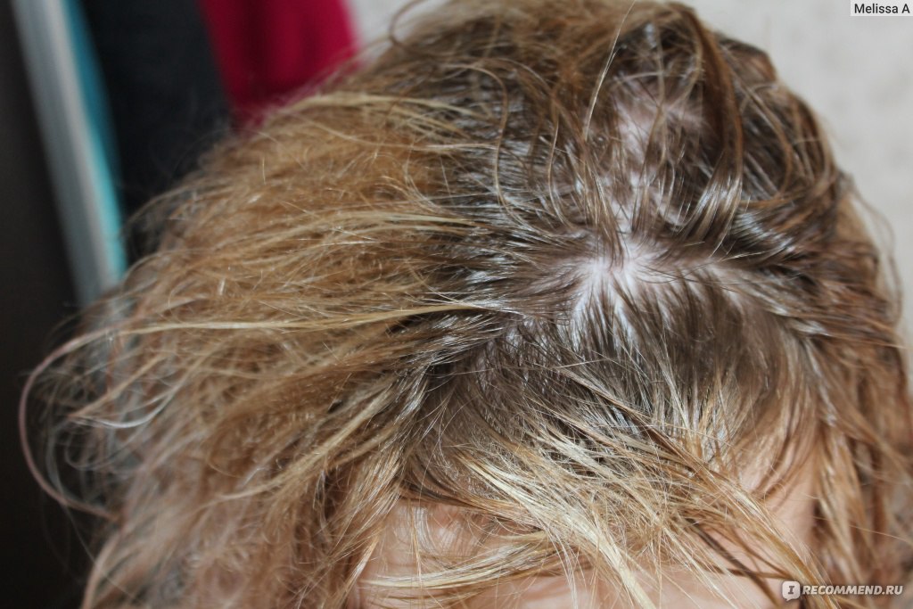 Почему выпадают волосы после мытья