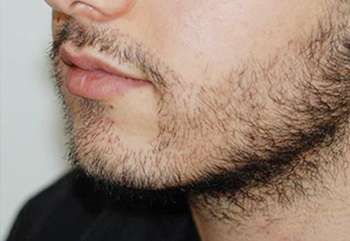Почему волосы на бороде тонкие