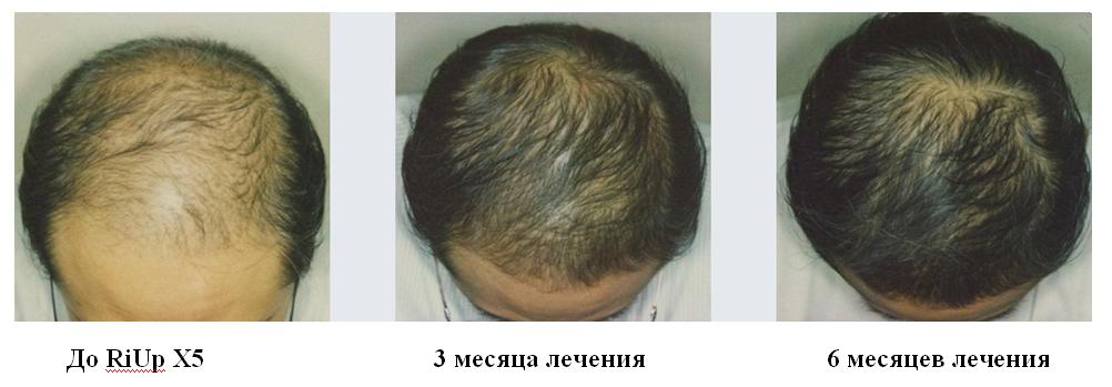 Химиотерапия рост волос
