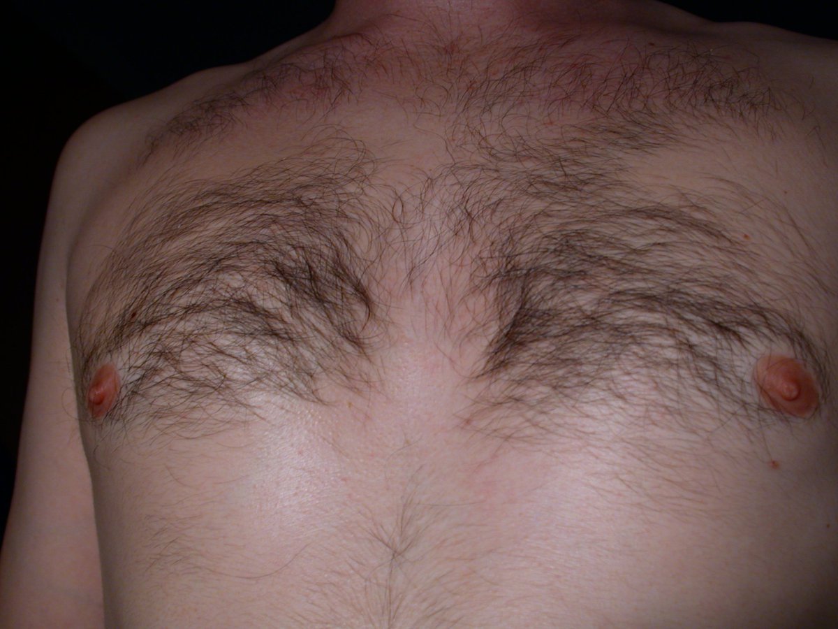 фурункул на груди у мужчин фото 4
