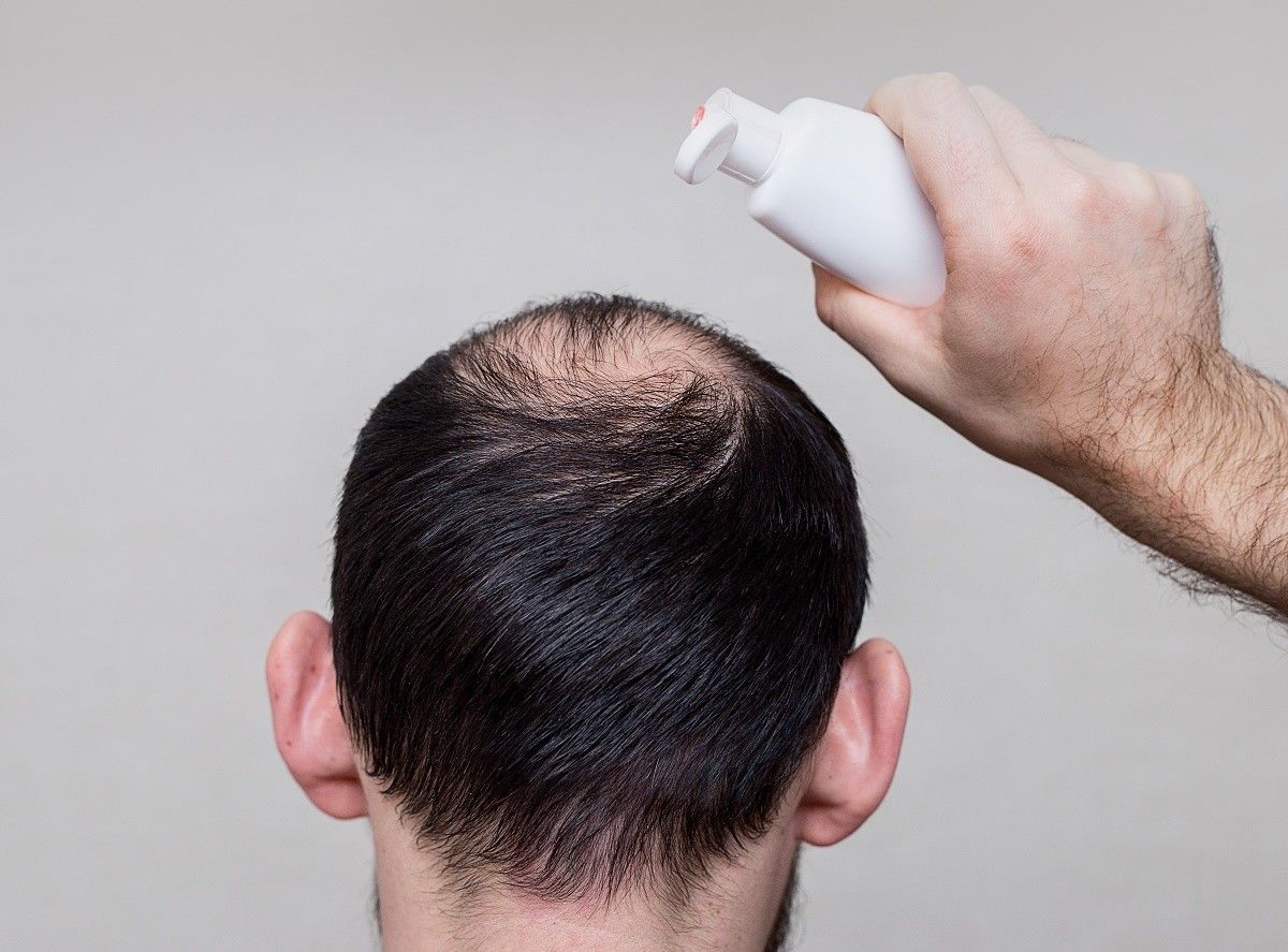 Выпадения волос форумы у мужчин