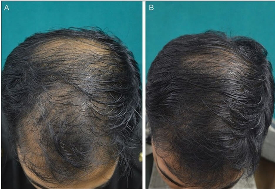 Причину выпадения волос после 40. Экозависимая алопеция. Дарсонваль алопеция андрогенная. Гнездовая алопеция у женщин.