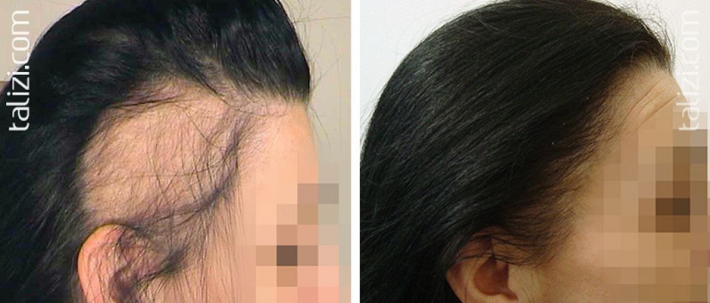 После лучевой волосы выпадают. Андрогенная алопеция у женщин. Поредение волос у женщин.