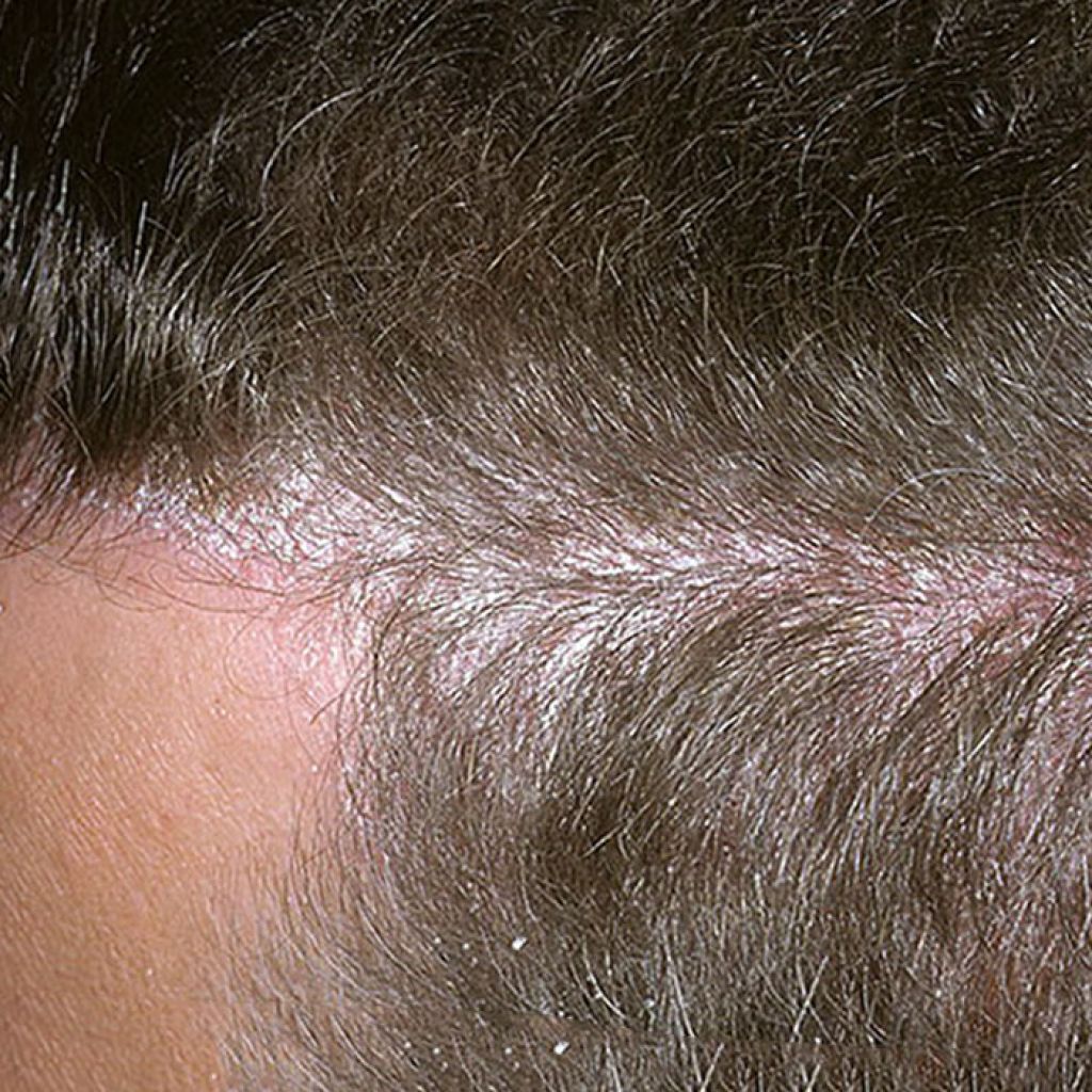 От чего выпадают волосы и шелушится кожа