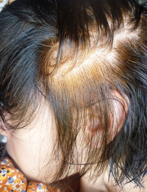 От краски выпадают волосы. Химический ожог кожи головы от краски для волос.