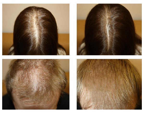 Почему медленно растут волосы на голове. Алерана миноксидил 5. Миноксидил алерана эффект. Алерана для волос после химиотерапии. Волосы после химии терапии.
