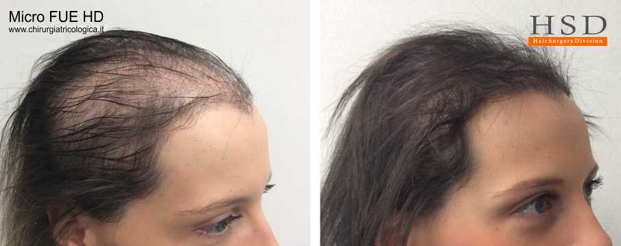 Можно ли уменьшить лоб с помощью пересадки волос