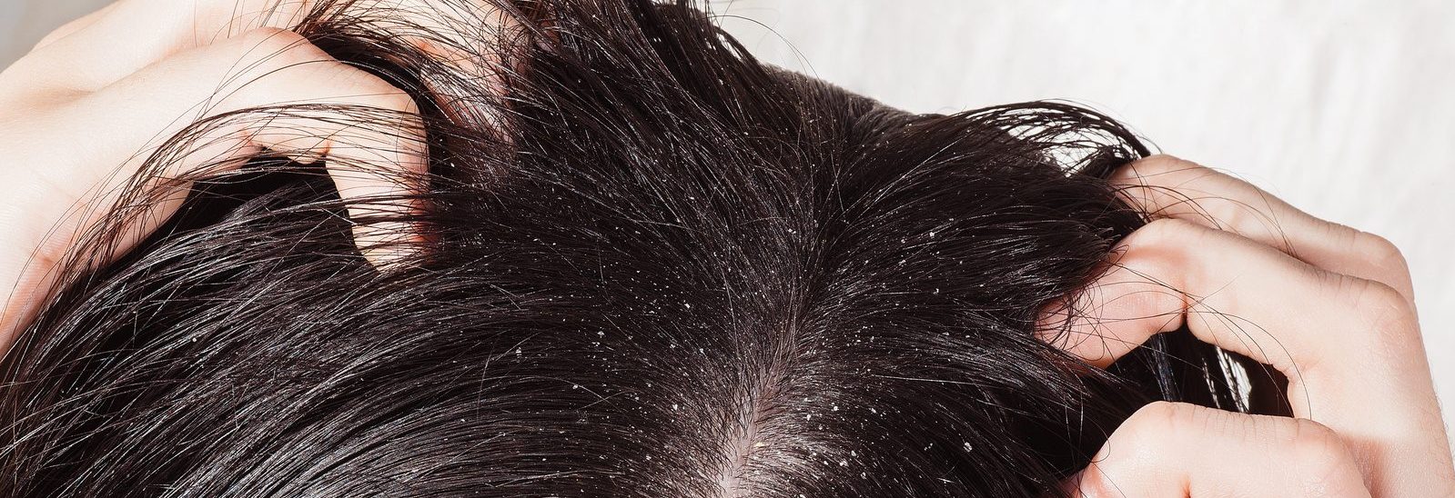 Аллергия на голове в волосах чем мыть голову