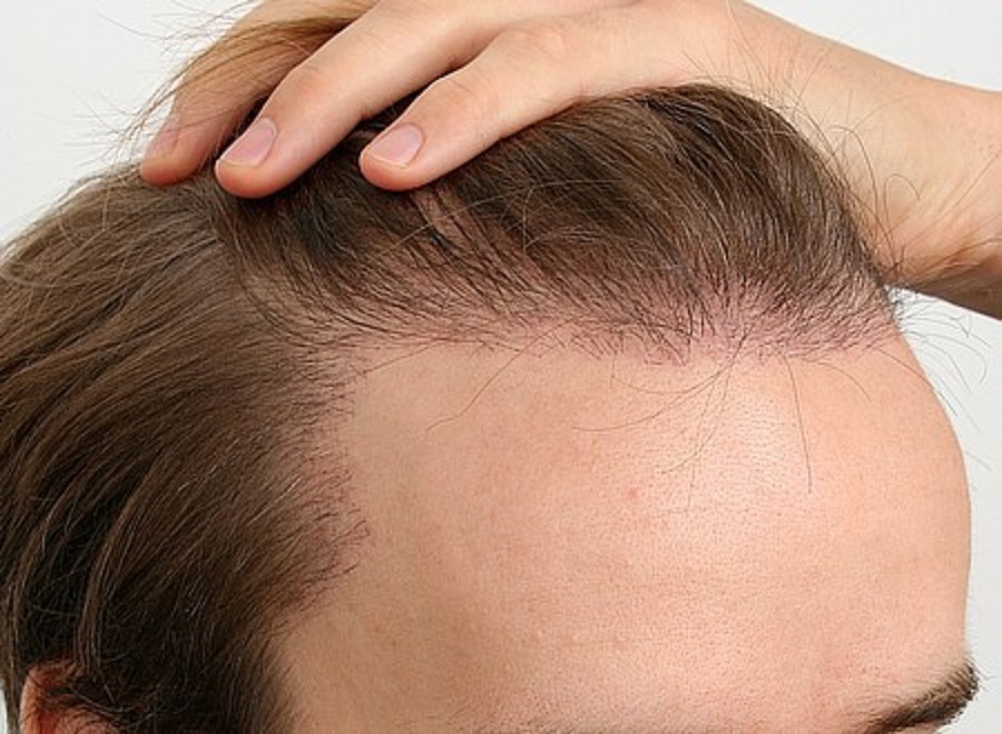 Причины выпадения волос у подростка. Линия волос. Линия роста волос на голове. Линия волос у мужчин.