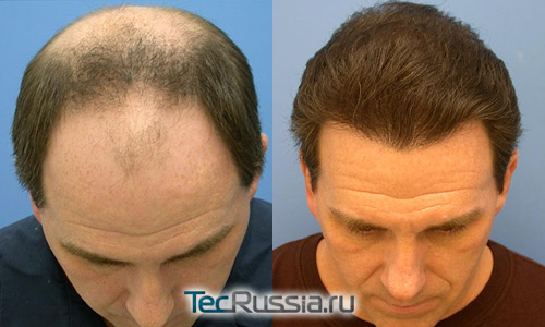 Фото до и после пересадки волос при алопеции