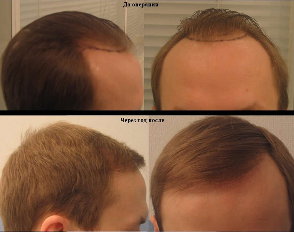 Как ускорить рост волос мужчине на голове. Миноксидил алерана эффект. Дарсонваль для волос до и после. Мезотерапия волос до и после. Мезотерапия волос мужчин.